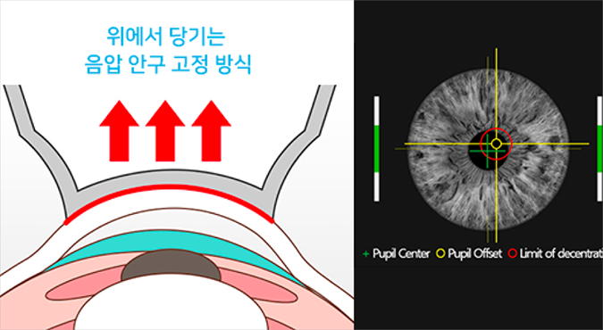스마일라식 석션로스 예방