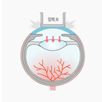 망막혈류에 영향없음 시야유지 이미지 