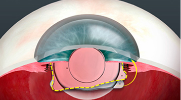 1st 수직형 난시교정ICL 개발