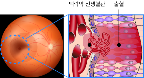 맥락막 신생혈관 출혈